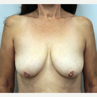 Saggy breast surgery before after