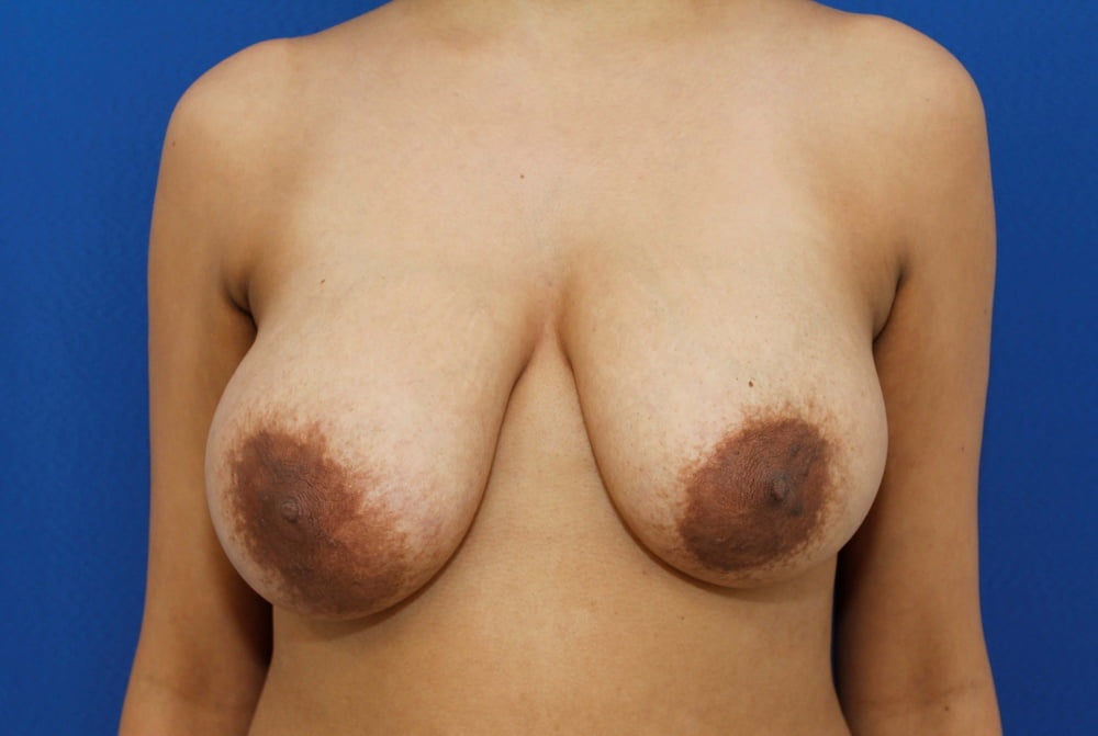 Breast reduction surgery after mastectomy-7980