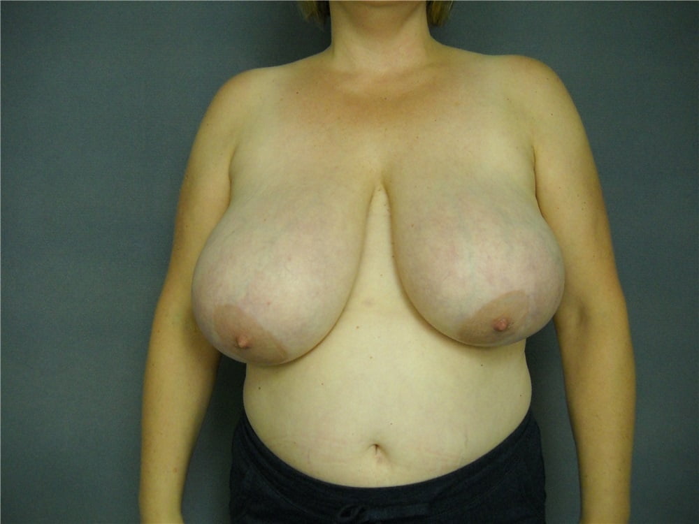 Top plastic surgeons for breast reduction-4913