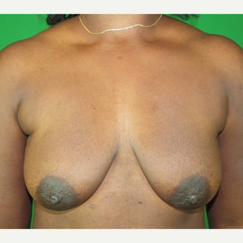 Saggy breast 45-54 - 104 Pics 