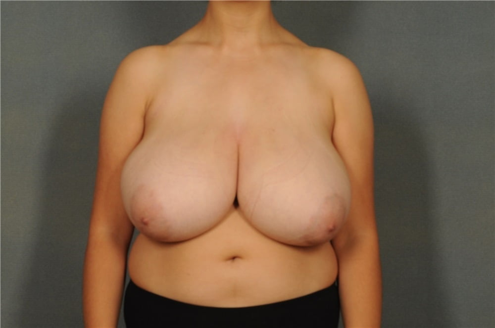 Top plastic surgeons for breast reduction-6520