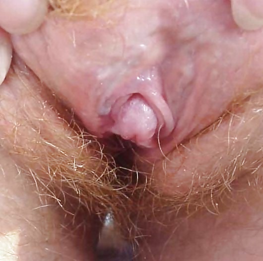 abnormal large Clitoris