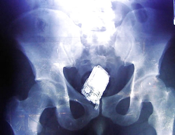 Porn Pics bad x-rays