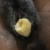Insertions