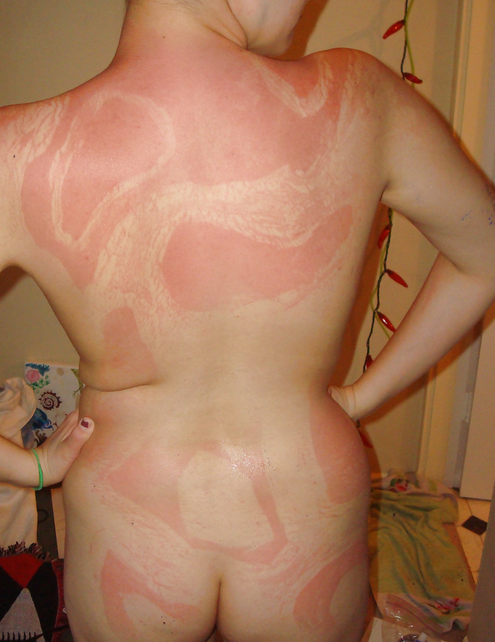 Porn Pics coup de soleil- sunburn